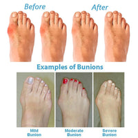 Women Correction Sandal Orthopedic Bunion